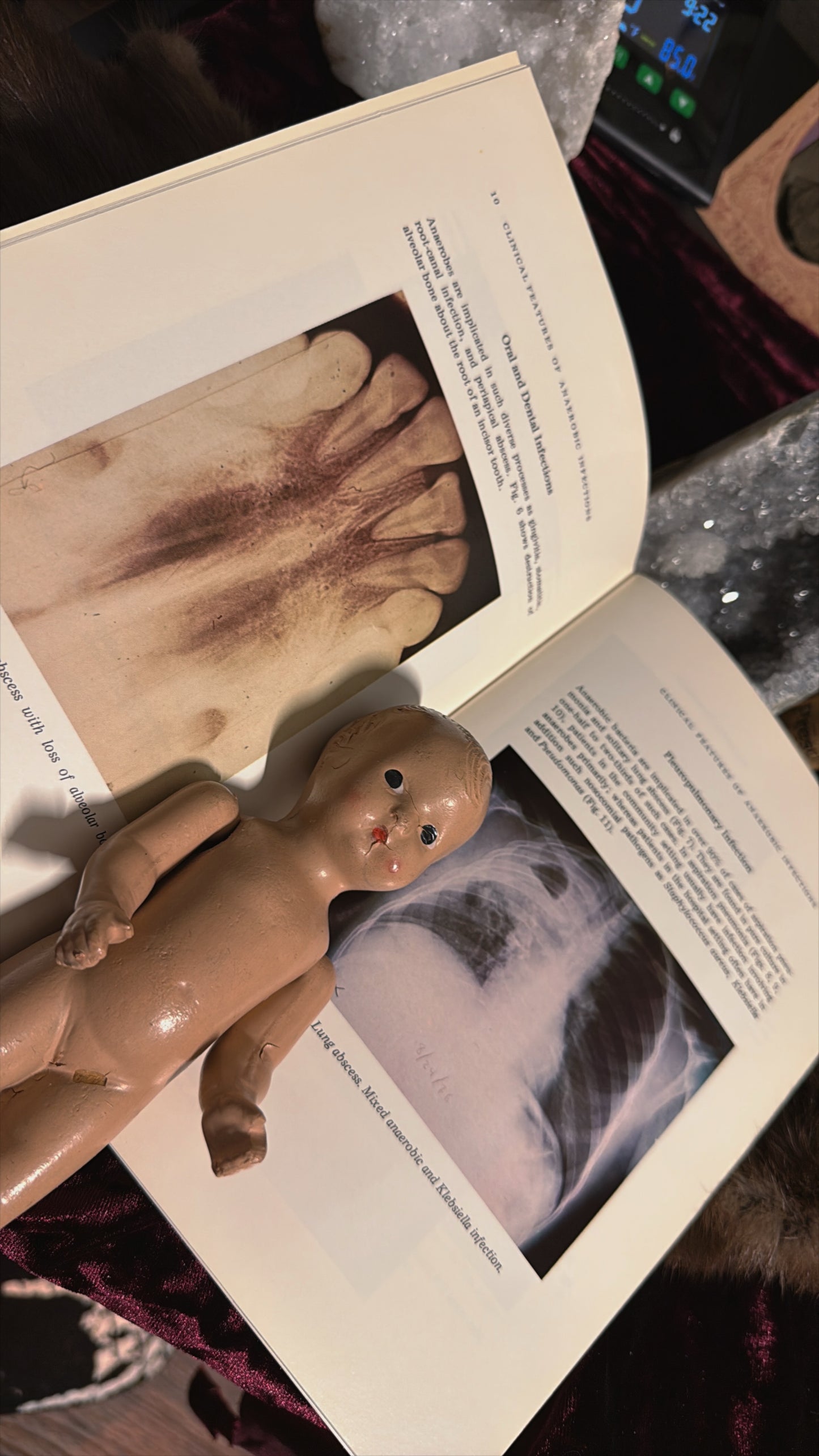 #86 1976 (1ct) Vintage Diagnosis & Management of Anaerobic Infections