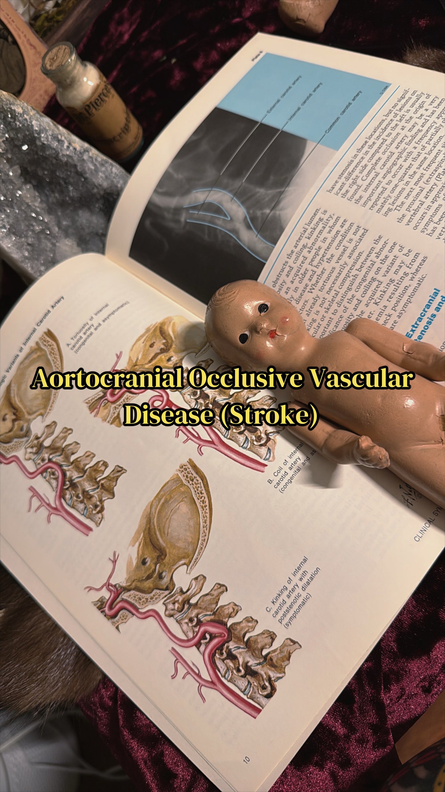 #85 ONE LEFT! 1970s Vintage Clinical Symposia books (set option)